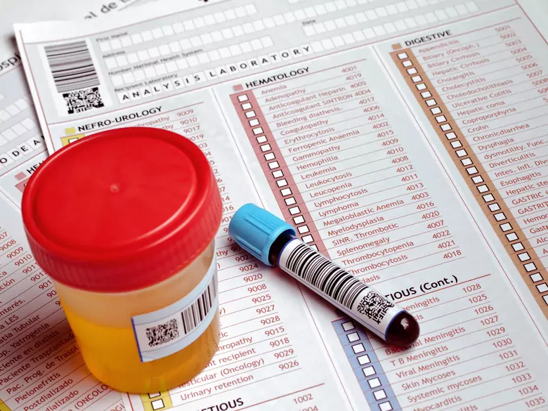 Bakterie w moczu - bakteriuria