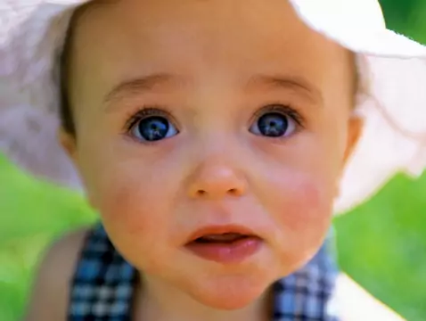 Toksoplazmoza wrodzona - przyczyny, objawy, diagnoza, leczenie