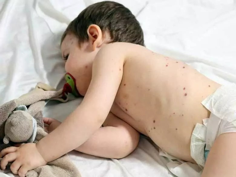 WHO ostrzega – znaczny wzrost zachorowań na odrę w Europie