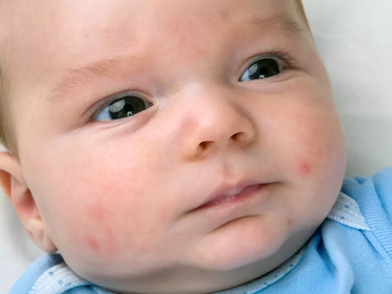 Alergia pokarmowa a wysypka – co powinien wiedzieć każdy rodzic?