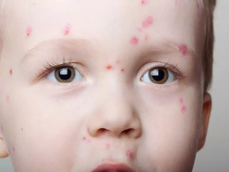 Przegląd wybranych chorób zakaźnych u dzieci