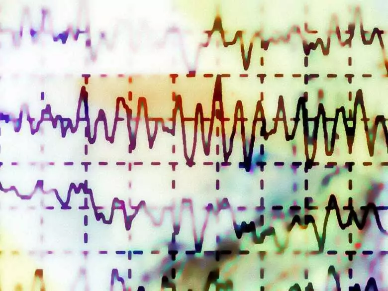 Kanałopatie - genetycznie uwarunkowane zespoły będące przyczyną zaburzeń rytmu serca