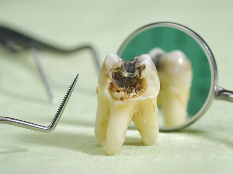 Celiakia sprzyja wadom szkliwa zębowego, ale nie zwiększa ryzyka próchnicy